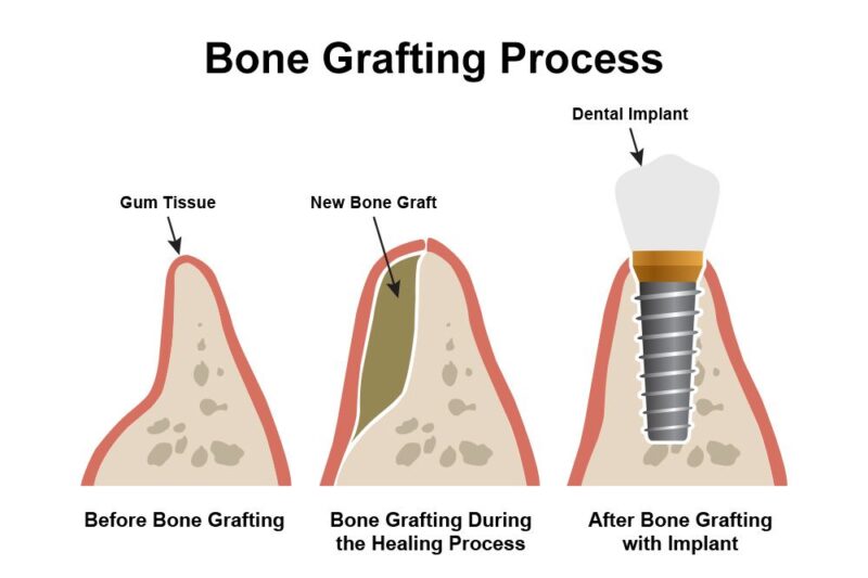 Curious About Bone Grafts Here’s What You Should Know