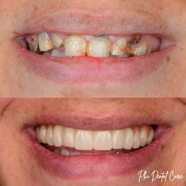 All-on-X dental implants before and after transformation