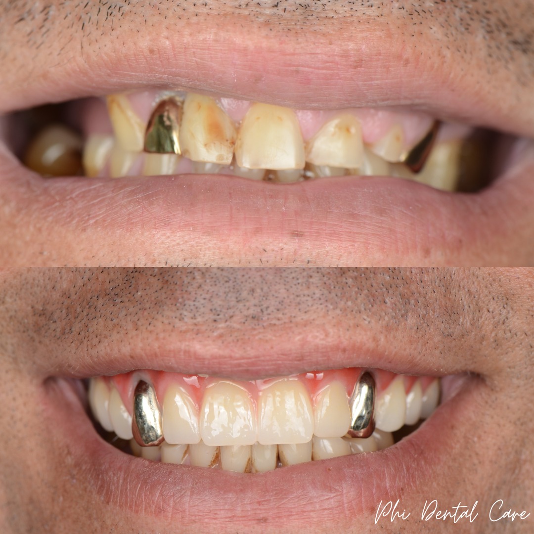 All-on-X dental implants before and after transformation