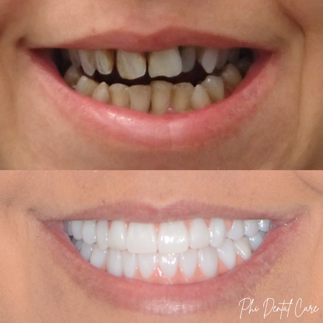 All-on-X dental implants before and after transformation
